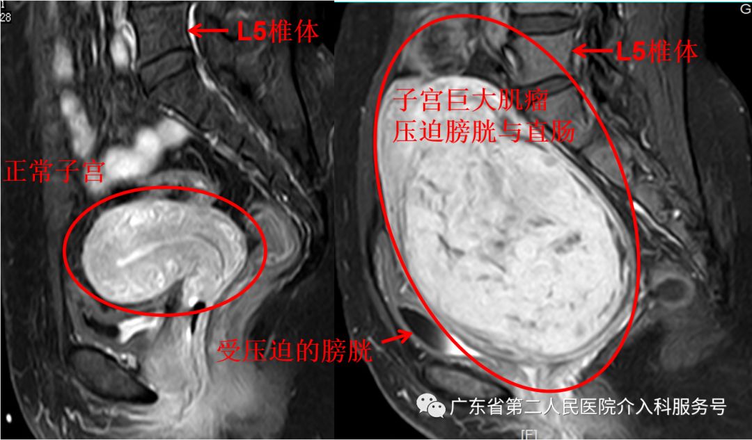 子宫肌瘤引起大姨妈一直来怎么办,子宫肌瘤大姨妈多怎么办