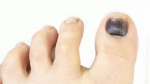 跑步脚上出现黑趾甲该怎么处理,跑步黑脚趾怎么处理