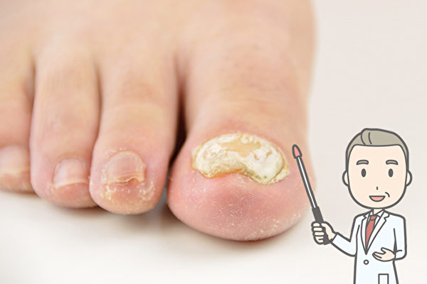 灰指甲易复发预防很关键,灰指甲怎么避免传染其他指甲