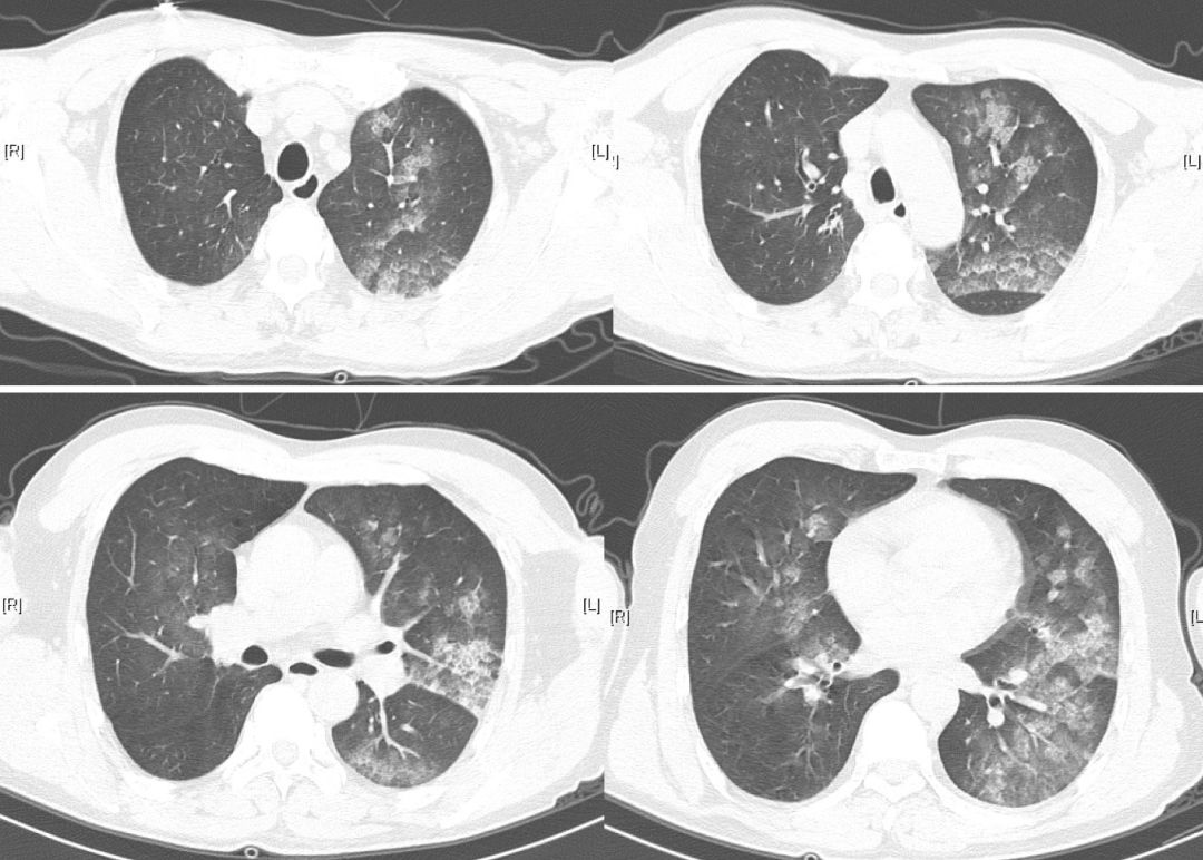工人用稀料清理泡沫10分钟即意识丧失，肝功能异常是否为切入点？