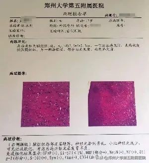 最先进有效的癫痫手术,癫痫手术是否能一次治愈