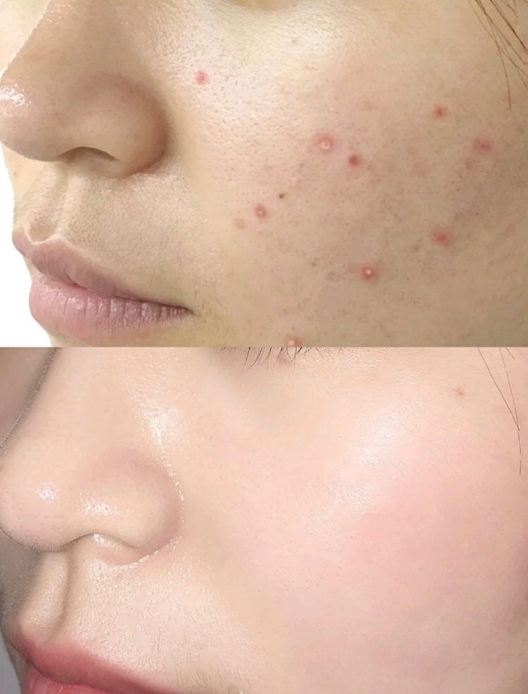 屈臣氏祛痘肥皂,沈梦辰最火的洗面皂