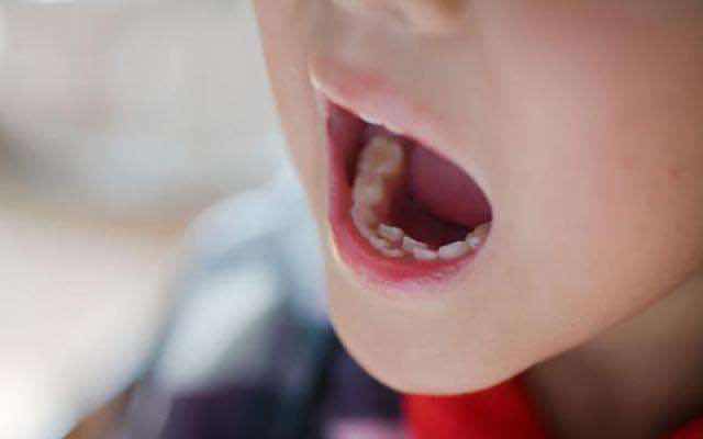 孩子换牙后牙齿变化图,孩子乳牙很好换牙都歪是怎么回事