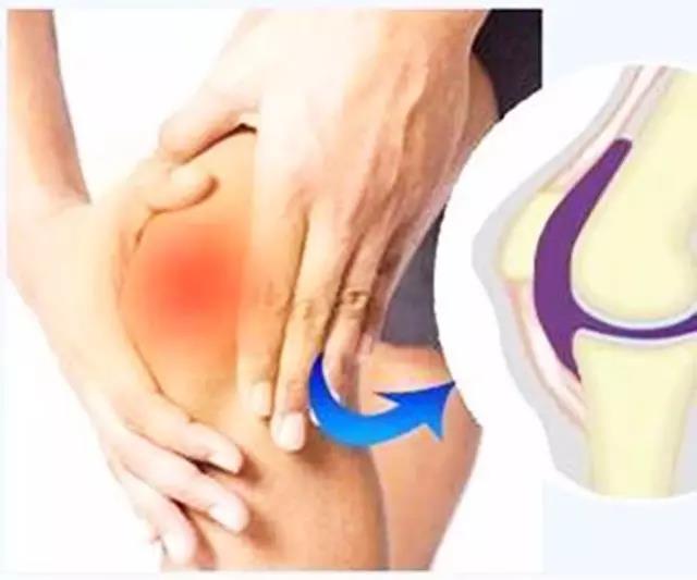 膝关节滑膜炎为什么怕凉,受凉引起膝盖滑膜炎能彻底治愈吗