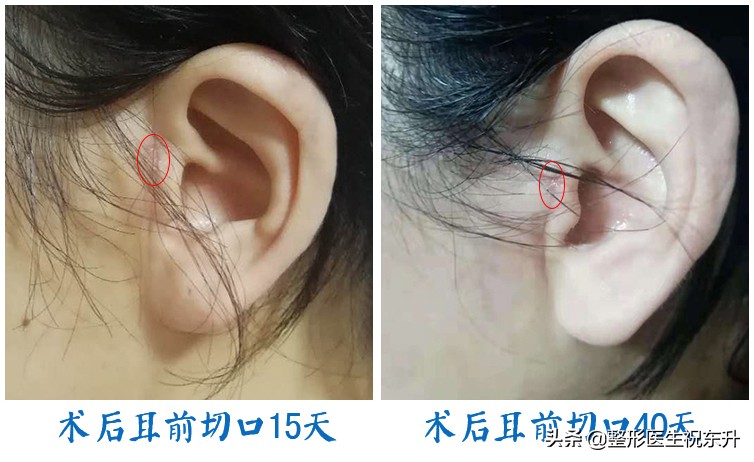 四十岁做拉皮的疤要多久会修复,拉皮手术后的疤痕处怎么修复