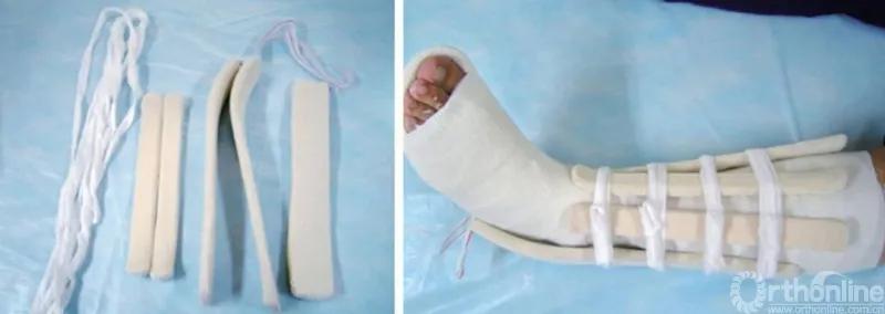 骨折闭合复位髓内钉内固定术,骨折闭合复位