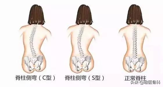 孩子高低肩的原因及危害,儿童高低肩的原因及危害