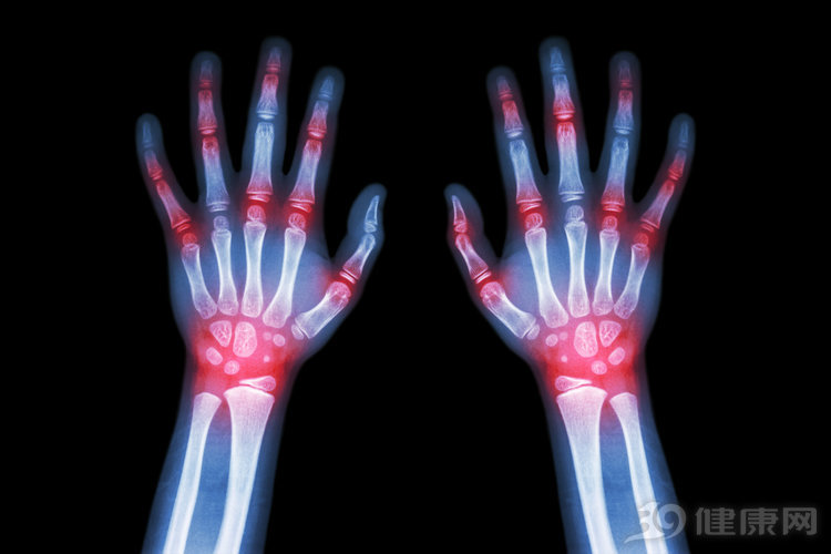 类风湿特效神药的真相,风湿病其实有特效药吃吗