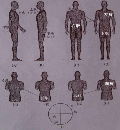巨刺与缪刺疗法视频,巨刺与缪刺区别