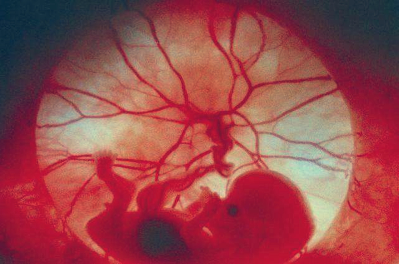 第一次孕检没看出来是双胞胎,孕初期看不到胎芽胎心怎么回事