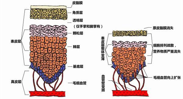 宝宝得湿疹妈妈怎么忌口,宝宝湿疹怎么调理身体才能断根