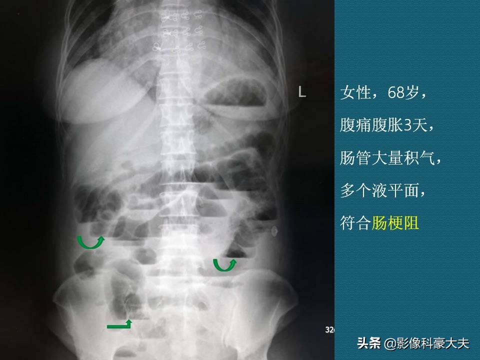 小孩便秘去医院洗肠全过程,六岁孩子五天没排便了怎么办