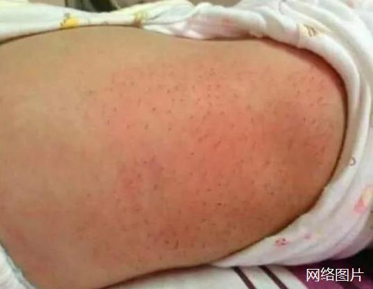 孩子被送医院治疗黄疸,婴儿黄疸长刺