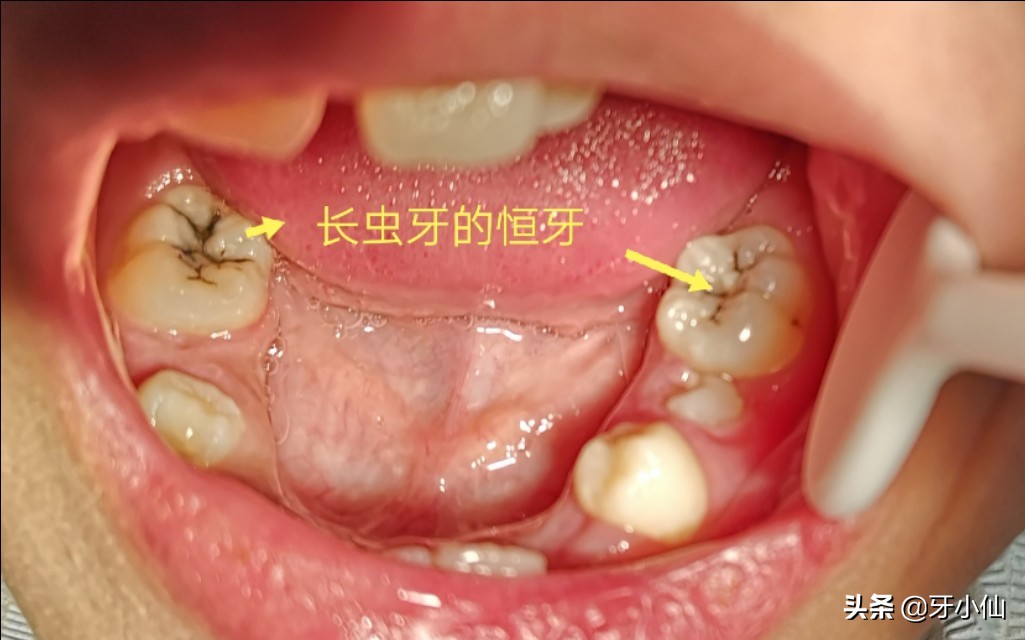 小孩子吃多了糖长虫牙,吃糖果不刷牙会有虫牙吗