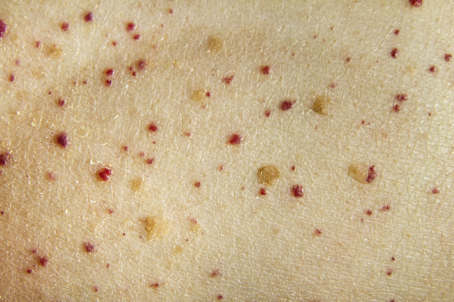 脸上去痣的最佳方法不留疤和坑,祛痣后脸上有凹疤痕怎么弄