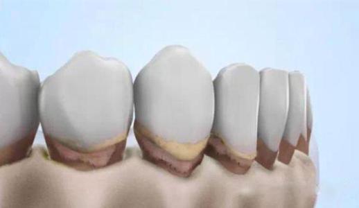 牙龈萎缩造成塞牙最好的解决办法,牙龈萎缩前牙黑三角严重如何修复