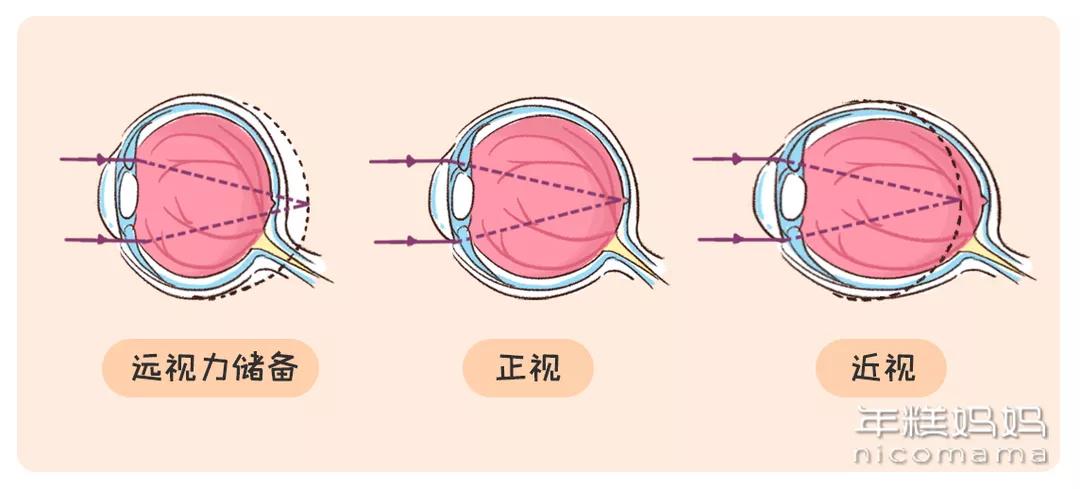 小朋友平板防近视,不看电视和手机孩子怎么还会近视