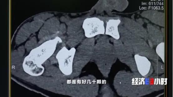 他被迫吞下72粒*洛因海**胶囊！突然，*品毒**破裂……