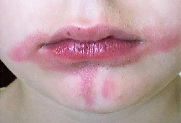 阳光下吃柑橙冰棍或冷饮，医生提醒，可能引起孩子植物阳光皮炎