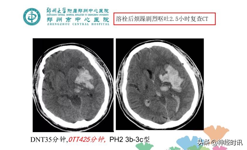 静脉溶栓怎么引起的,静脉相关并发症的预防及处理