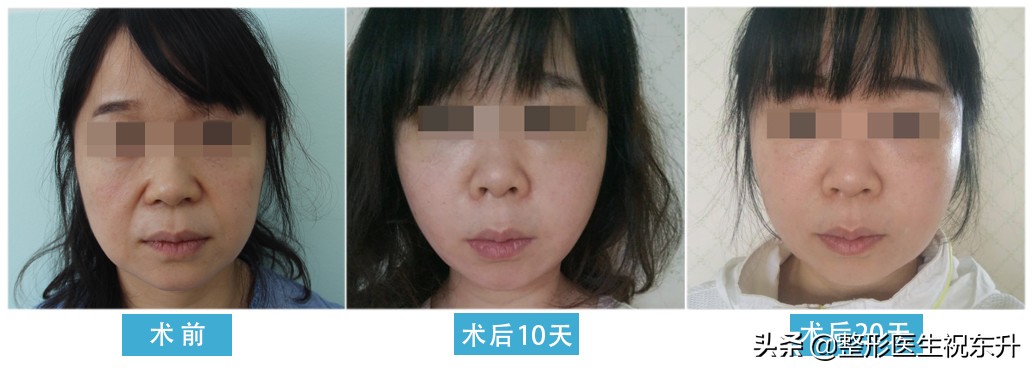 拉皮手术后的疤痕处怎么修复,腹部拉皮手术能去除剖腹产的疤吗