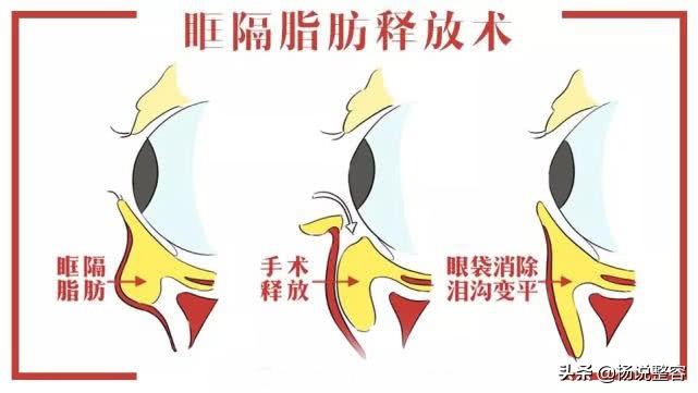 眼袋不仅难看,还特别显老,那么哪种去眼袋方法比较好呢?