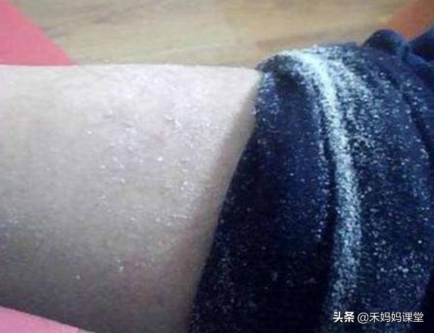 冬天一脱秋裤有大量皮屑是缺什么,一脱秋裤皮屑满地飞