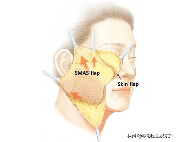 去皱整容的危害到底有多大,整容拉皮和脸部提升的区别