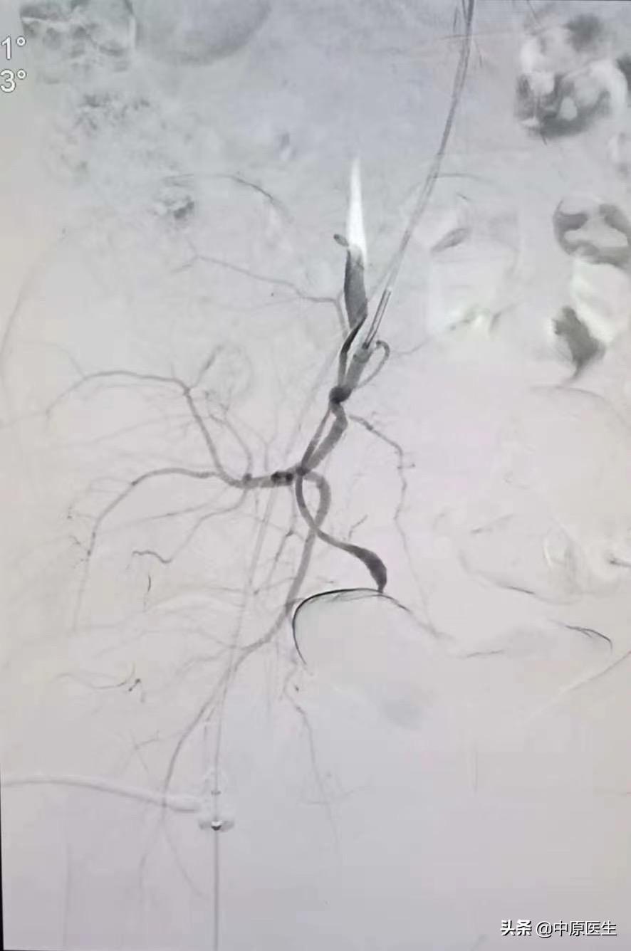 如果自己强烈要求剖宫产可以吗,专家提醒不能生育