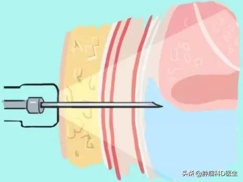 肺癌胸水控制了说明好转了吗,有胸水了还可能是早期肺癌吗