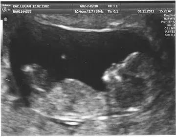 超声检查和b超检查哪个准确,超声b超能检查出什么