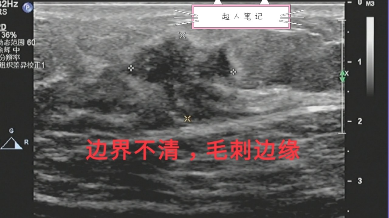 乳腺癌彩超能看出淋巴异常吗,乳腺结节和乳腺癌彩超区别