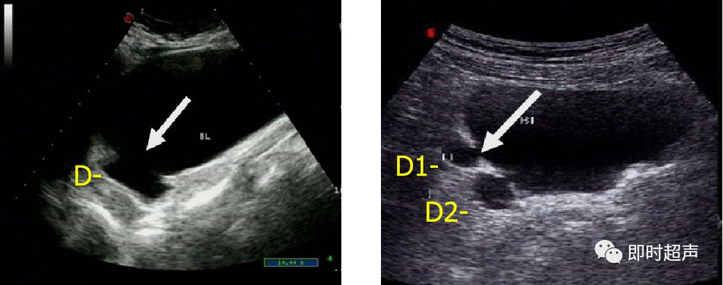 膀胱超声图解大全,膀胱超声解剖及常见病变超声表现