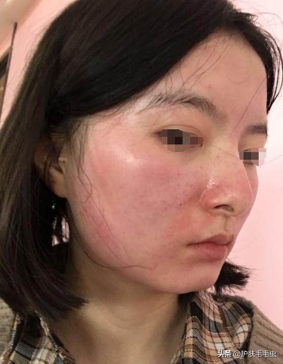 微晶祛斑骗局揭秘,微晶祛斑效果好不好