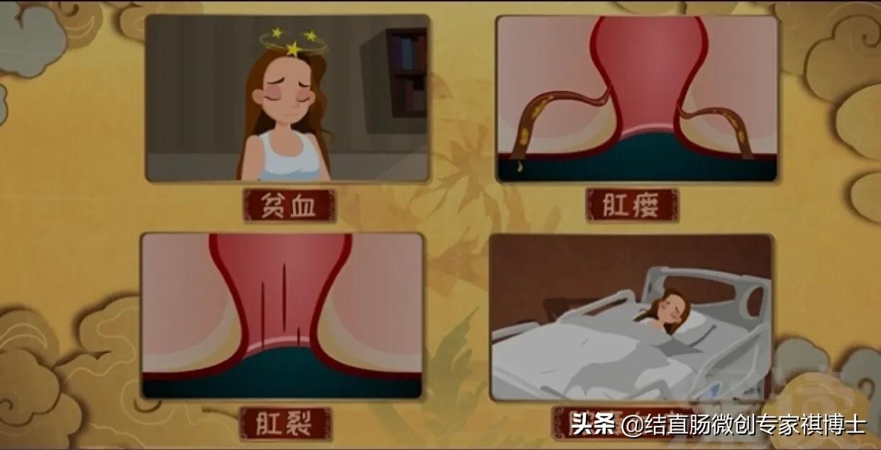 什么是混合痔疮的症状,得了痔疮会有哪些症状