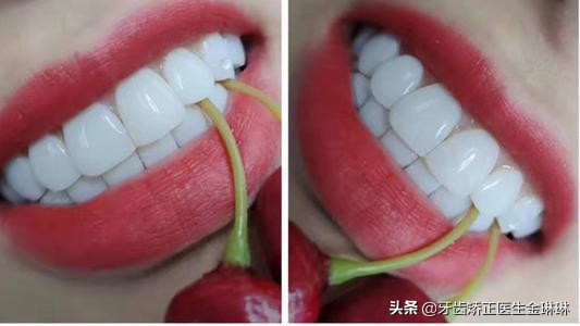 淄博烤瓷牙多少钱一个,淄博中心医院烤瓷牙