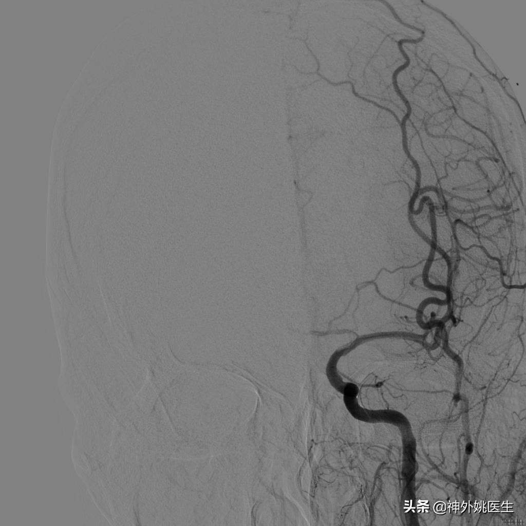颈动脉狭窄的外科治疗