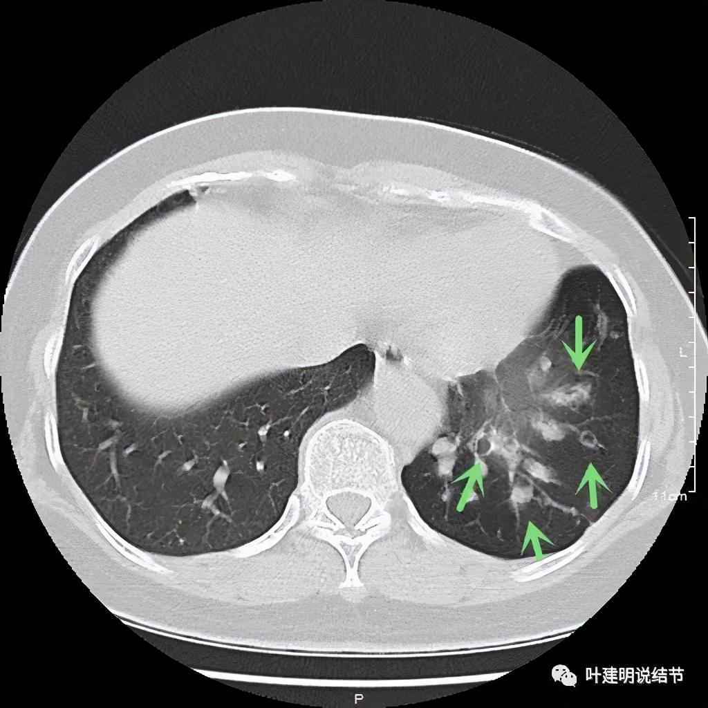 这样的实性结节伴小空洞会是肺癌吗？