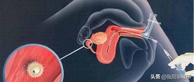 「张院讲故事」一直“通畅”的输卵管，为啥突然就功能异常了？