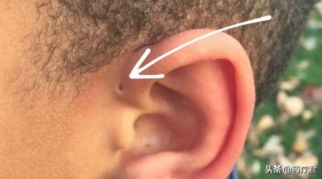 宝宝耳朵旁长小孔妈妈要正确应对,宝宝耳朵上有小孔需要手术吗