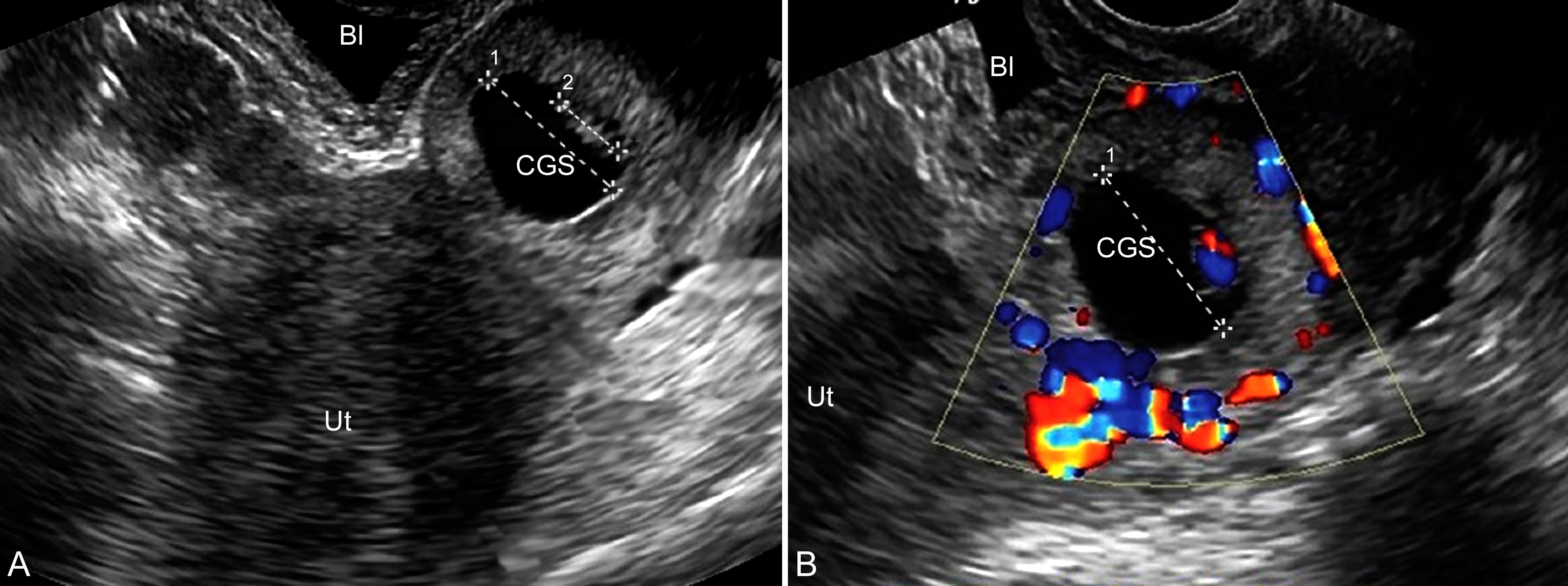 宫颈妊娠的超声表现,超声诊断出来宫颈妊娠吗