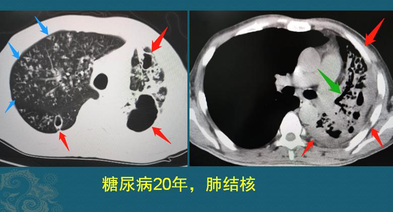 糖尿病不注意饮食的危害科普视频,糖尿病不忌口吃糖的后果
