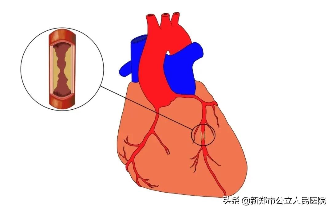 冠脉造影科普宣讲,冠脉CT血管造影