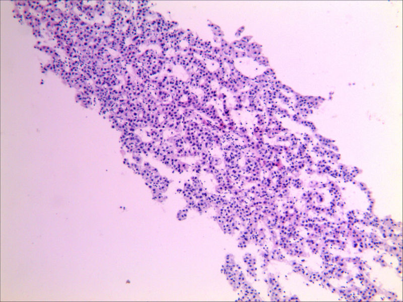 乙肝病人转氨酶高对肝有什么影响,慢性乙肝引起转氨酶高200