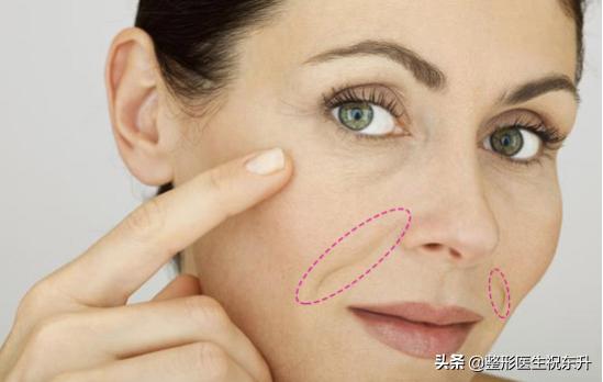 去除法令纹什么手术最好,微创祛除法令纹怎么做