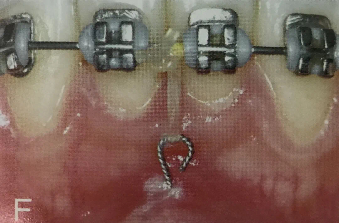 矫正牙齿在牙龈打钉子多久能取,整牙一定要在牙龈里打钉子吗