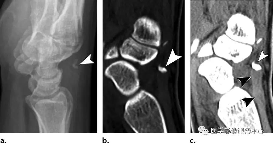 手腕撕脱性骨折一年了还隐隐作痛,手腕三角骨撕脱骨折症状有哪些