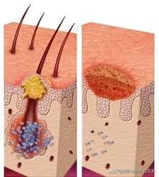 毛囊炎8种皮肤病偏方,皮肤病毛囊炎