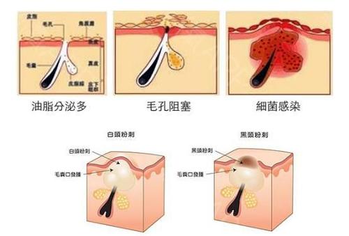 痘痘相关问答,疮疡是脸上的痘痘吗