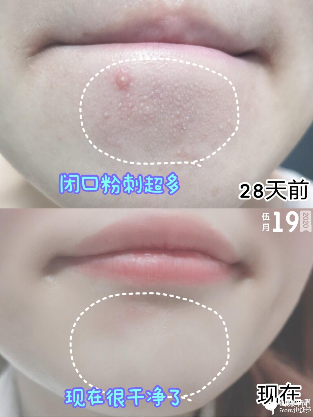 闭口粉刺怎么彻底去除小妙招,闭口粉刺怎么彻底去除不再长